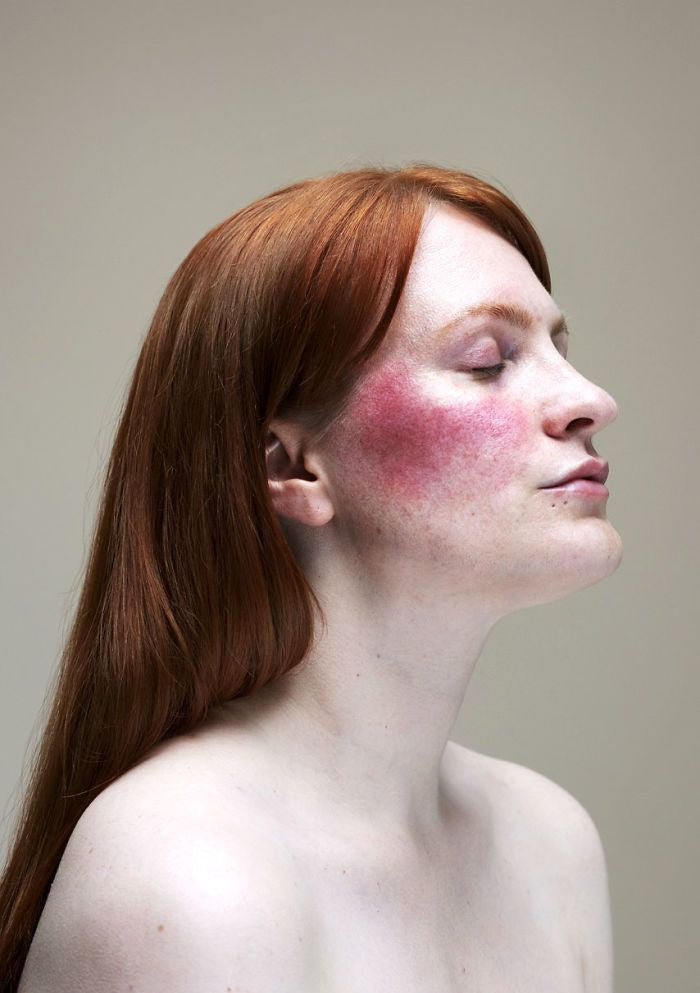 Rosacea: Understanding the Causes, Symptoms, and Skincare Tips for Sensitive Skin